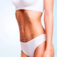 Liposuction in Turkey: Excellence in Cosmetic Surgery at Celyxmed